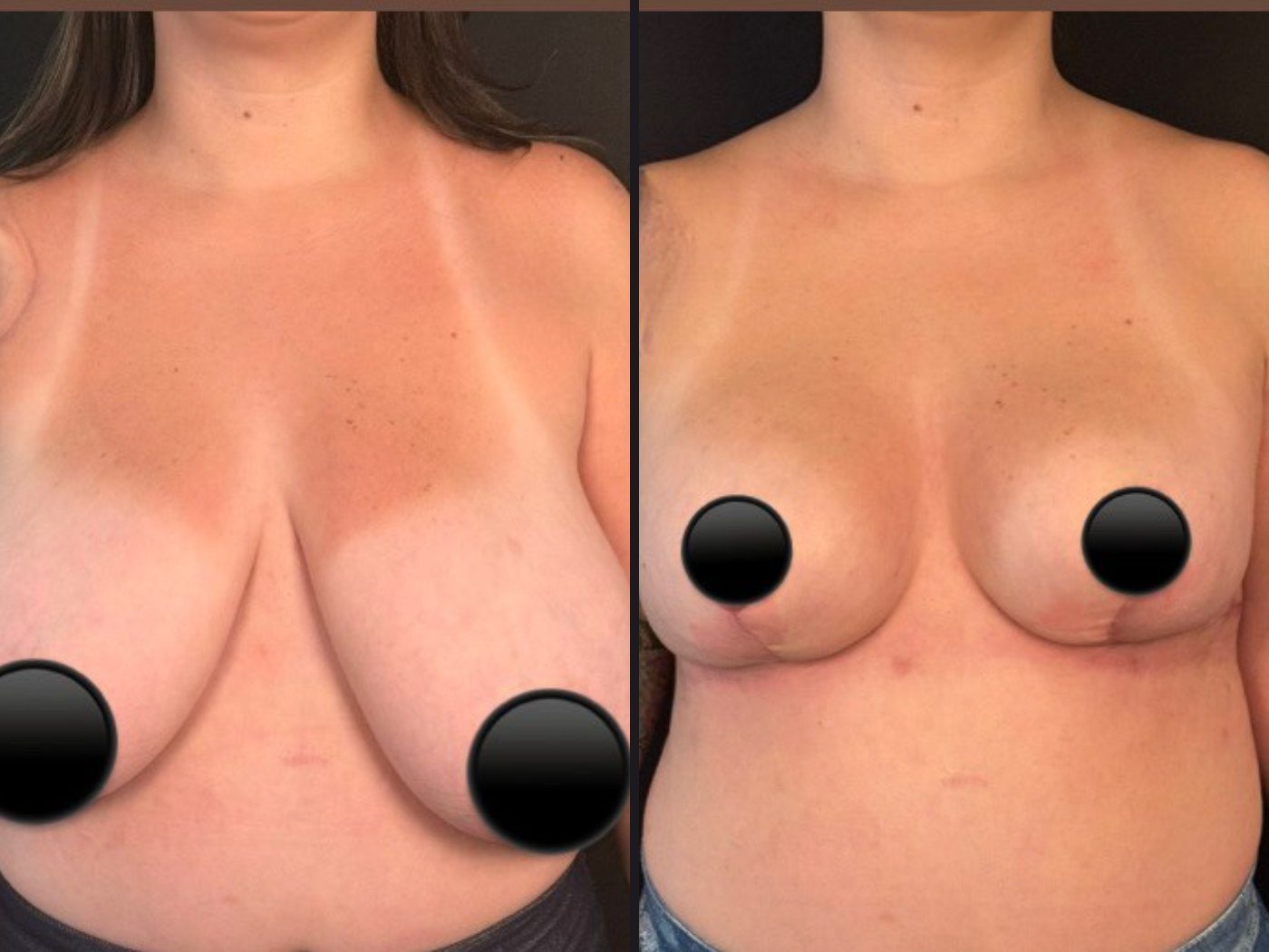 Antes e depois · mamoplastia redutora · Dr. Bruno Yuki Matsumoto