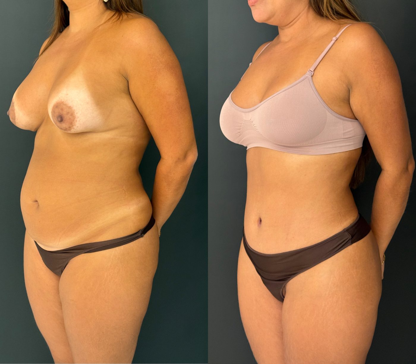 Antes e depois de abdominoplastia por Dr. Joao Pedro Estima