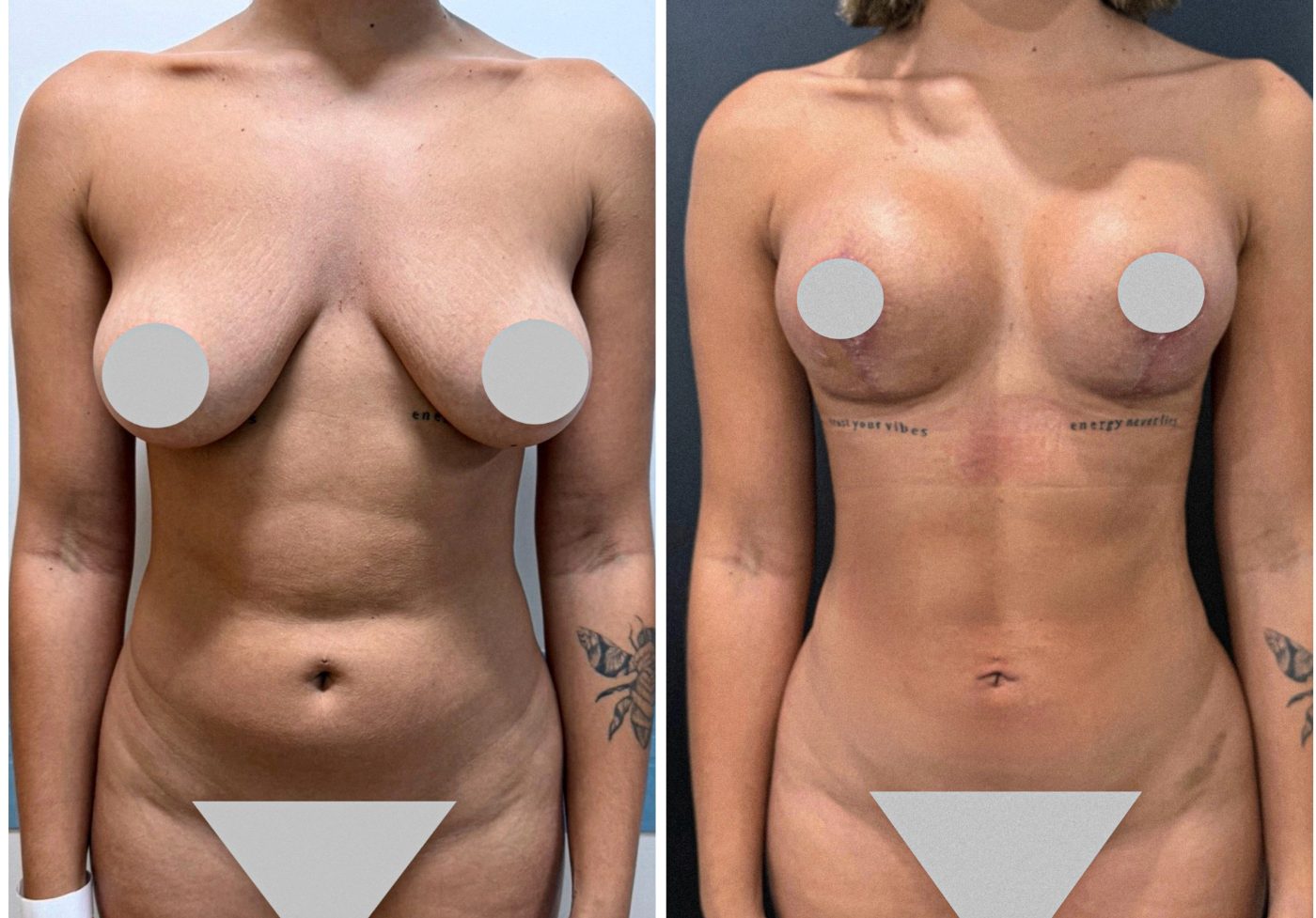 Antes e depois de lipoescultura por Dr. Leandro Gregório