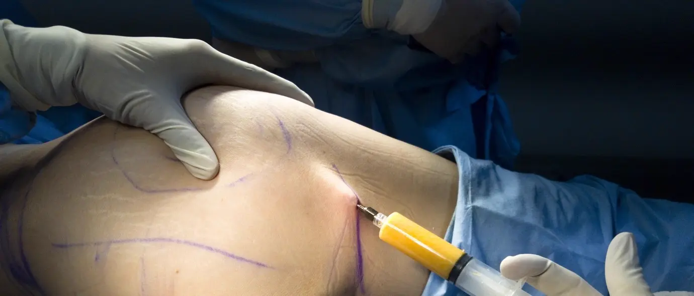 Lipoescultura vs. Lipoaspiração: Entendendo a Diferença — e Qual É a Certa para Seus Objetivos